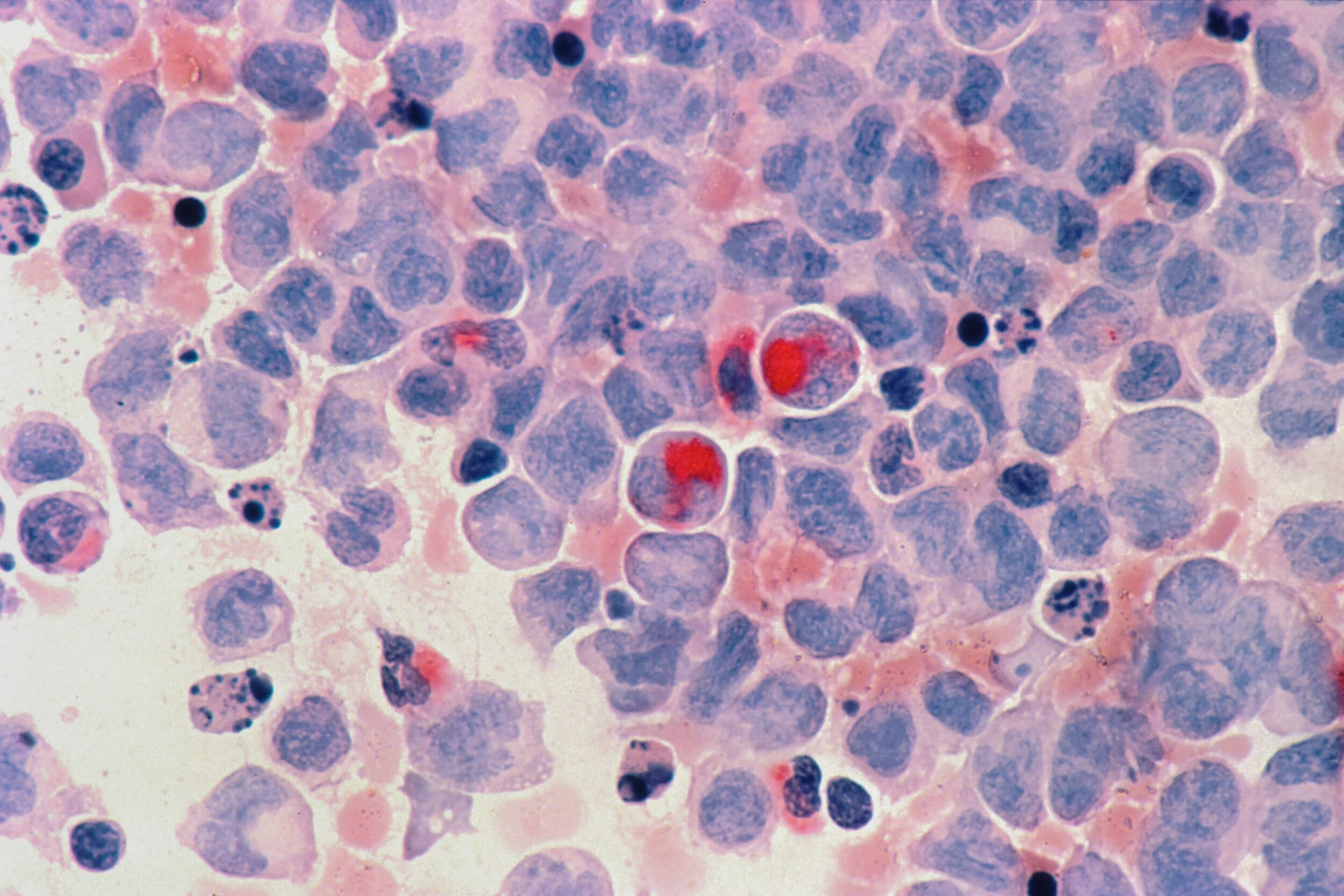 Acute myeloid leukaemia cells